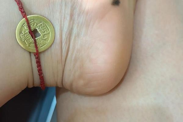 男人右脚脚底一颗痣的命运解析：暗示财富与健康的象征！