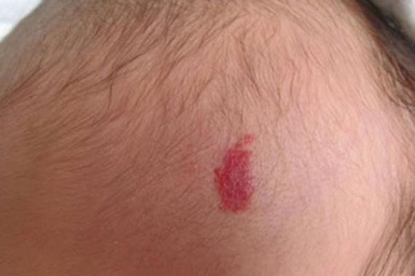 胎记与命运：揭秘女人胎记背后的真实寓意与人生轨迹