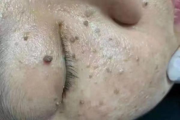 揭秘累志与妖痣相学：命运与运势的深层联系