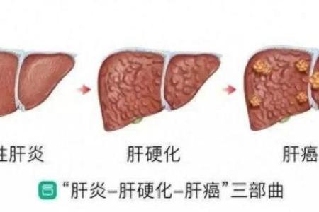 命理缺什么，肝病来袭的真相与应对策略