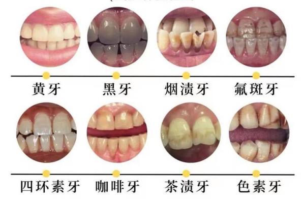 女人22颗牙是什么命？揭示牙齿与命运的神秘关系！