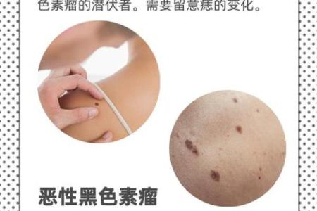 探秘:男人右背腰长痣为何被认为命好?