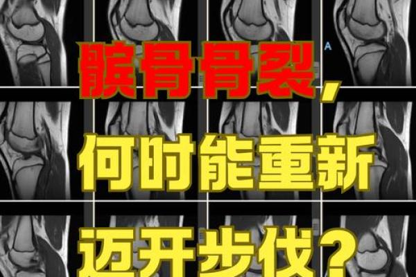 命里注定的髌骨骨折：背后的原因与自我保护指南